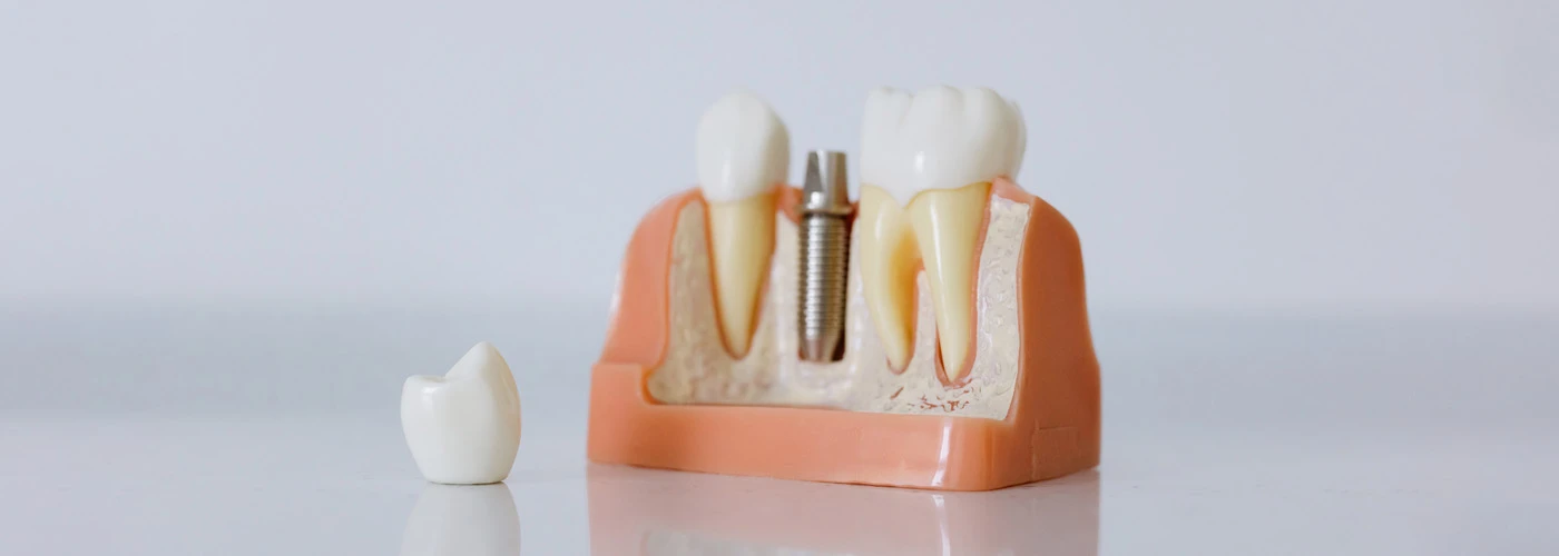 implantes dentales 22k