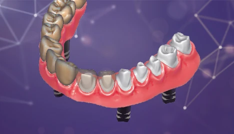 implantes dentales 22k