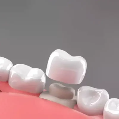 coronas dentales 3d