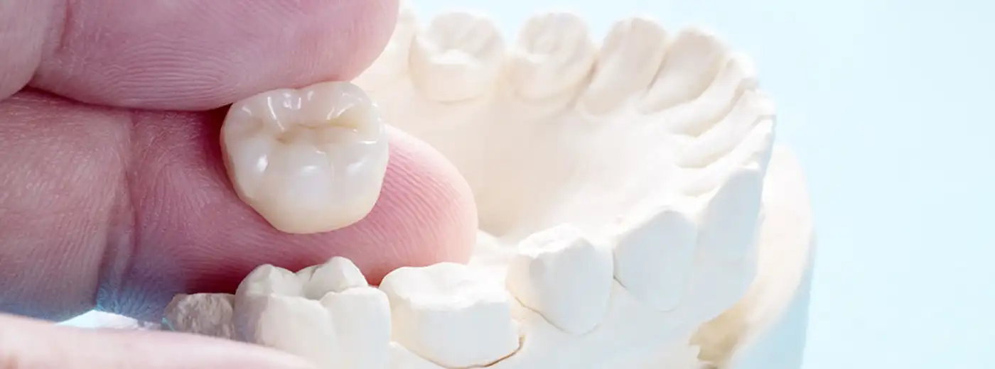 coronas dentales 3d