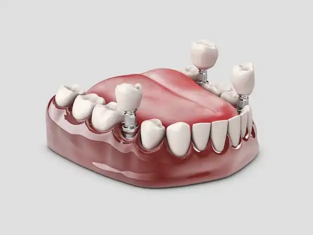 implantes dentales impresoras 3D