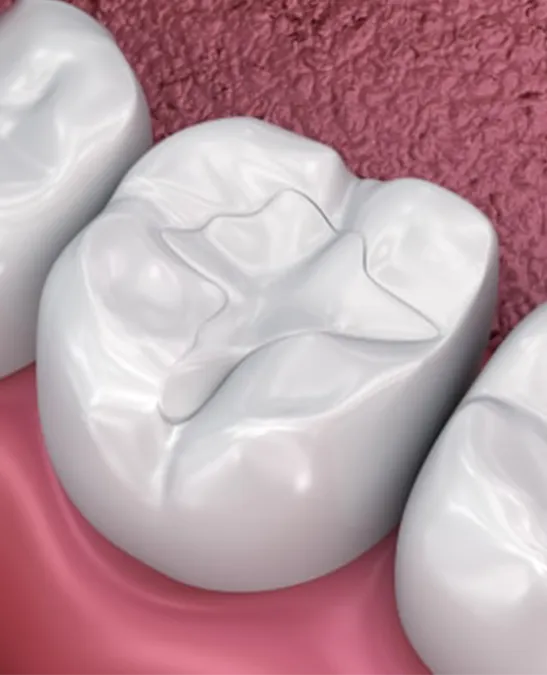 Tipos de Empastes Dentales Amalgama
