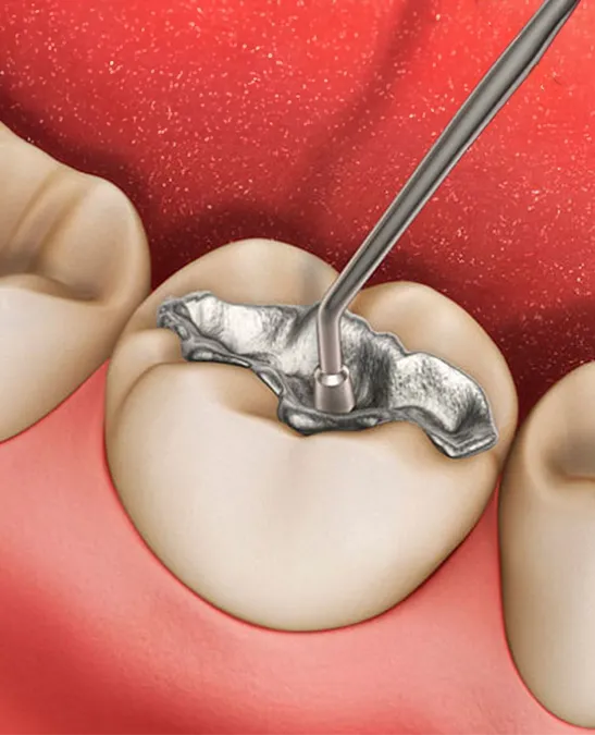Tipos de Empastes Dentales Metalico