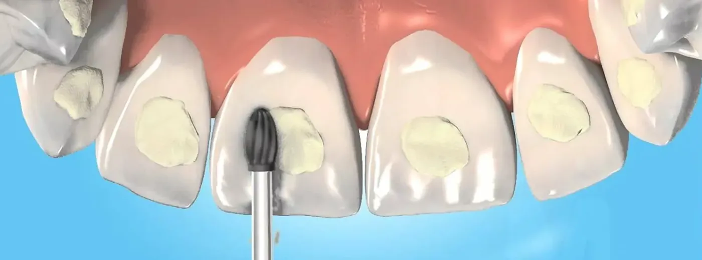 Tipos de Empastes Dentales Portada