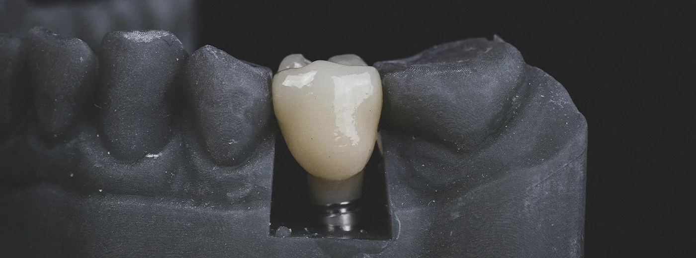 Muestra de Implantes Dentales 3D