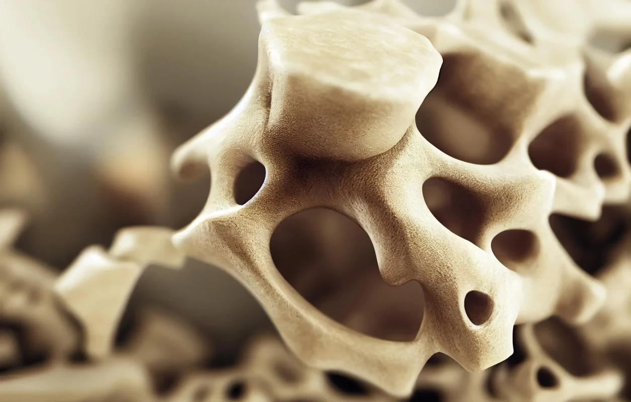 Impacto de la Osteoporosis Bucal Ejemplo