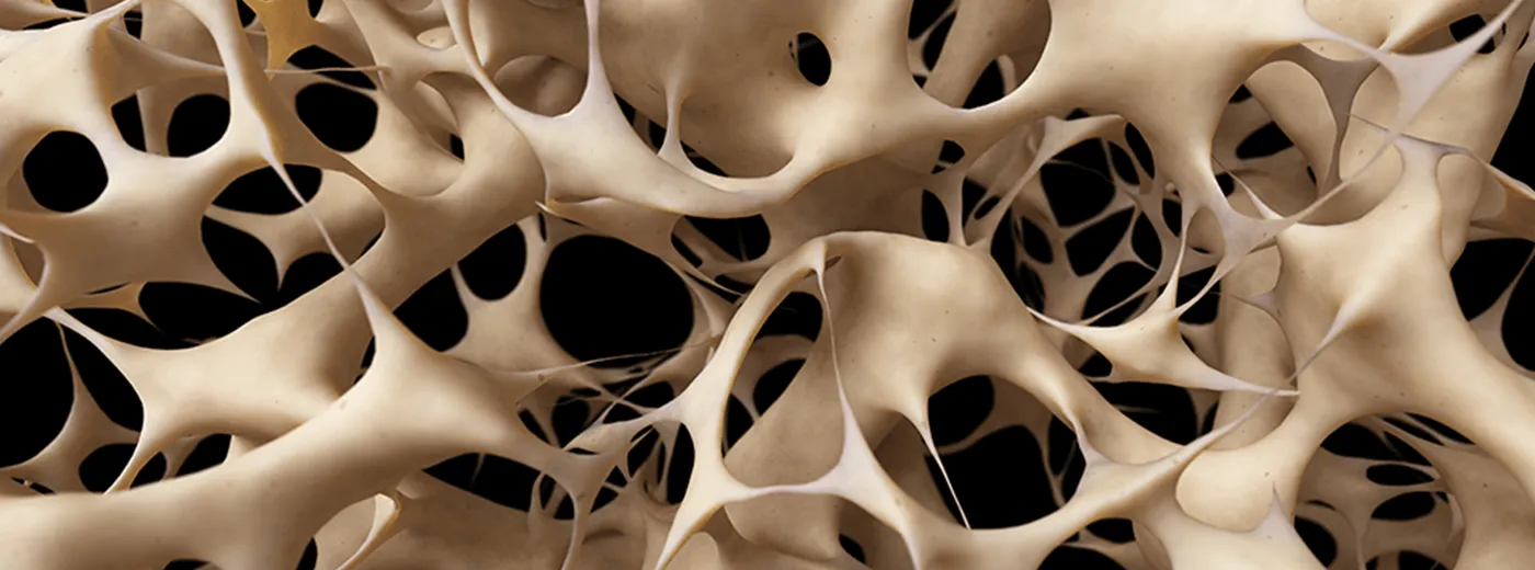 Impacto de la Osteoporosis Bucal en la Salud Dental