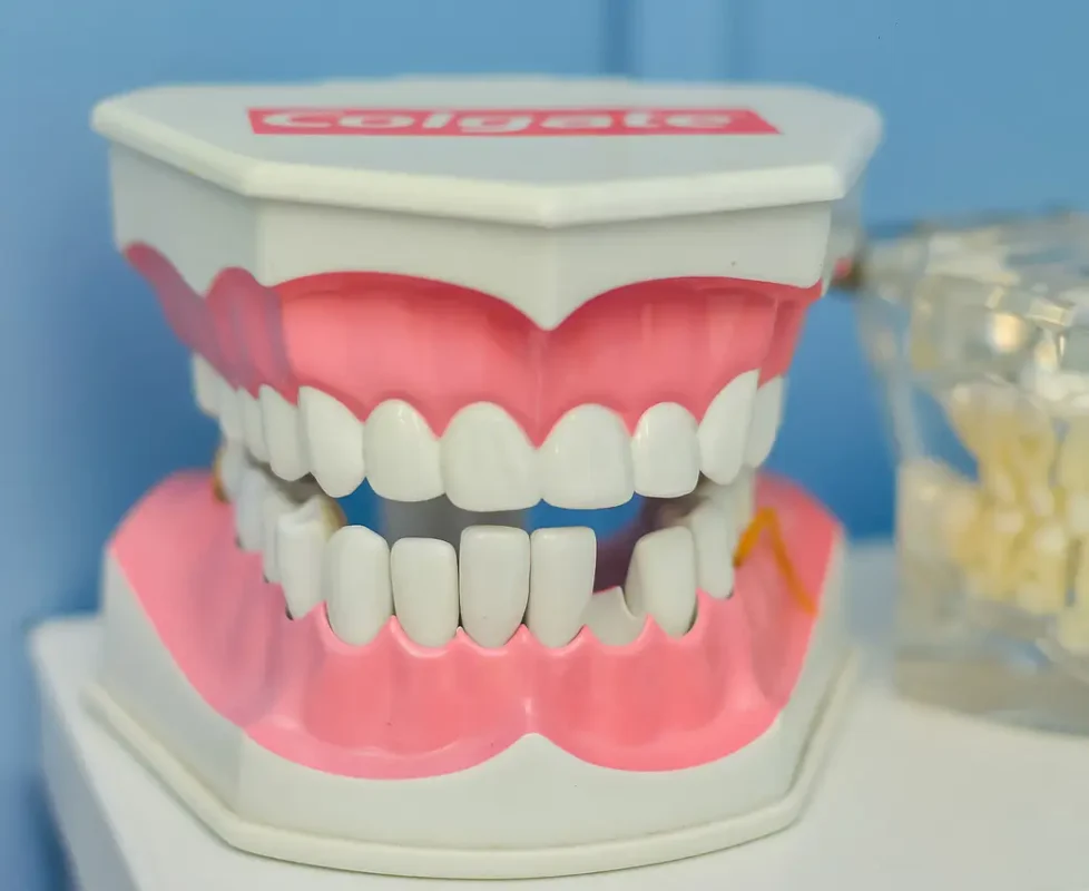 Muestra de Implantes Dentales 3D