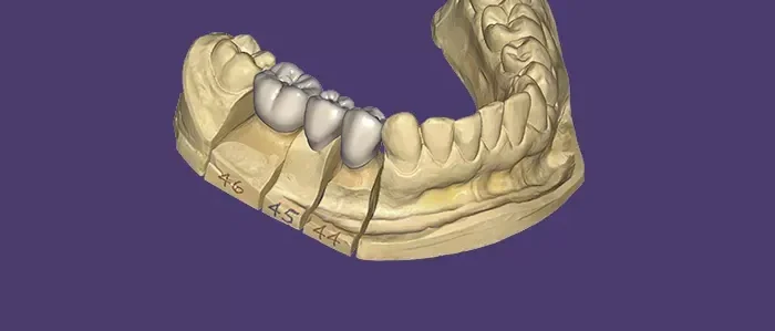 Exocad Dental