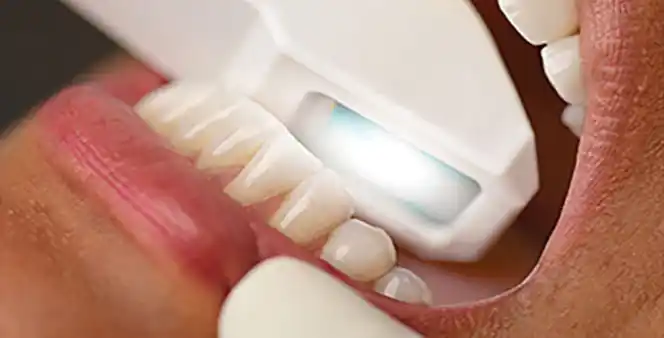 Escáner Intraoral