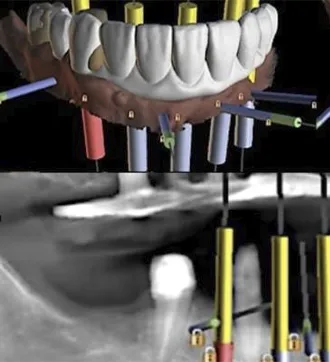Rehabilitación con impresión 3D